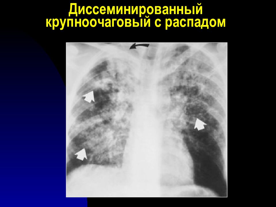 Лучевая диагностика органов дыхания презентация