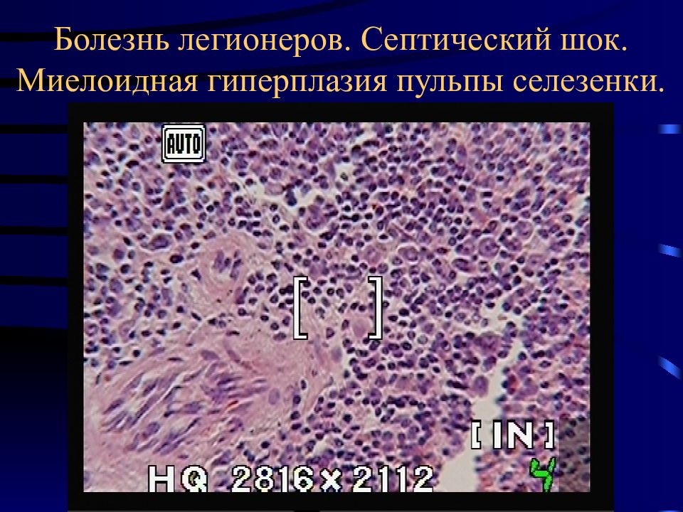 Сепсис патанатомия презентация