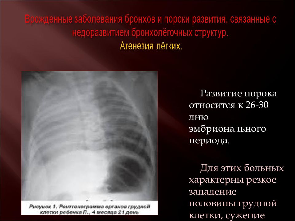 Развитие легких. Врожденные аномалии органов грудной клетки.. Пороки развития грудной полости. Пороки развития грудной клетки. Врожденные пороки развития грудной клетки.