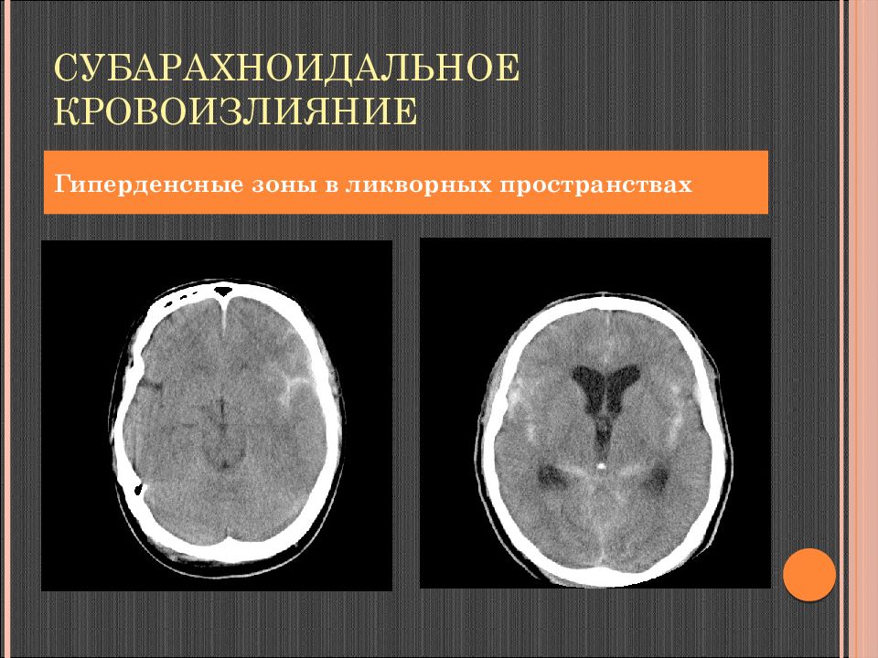 Мр признаки расширения субарахноидального пространства. Кт при субарахноидальном кровоизлиянии. Травматическое субарахноидальное кровоизлияние кт. Субарахноидальное кровоизлияние кт протокол. Субарахноидальное кровоизлияние кт картина.