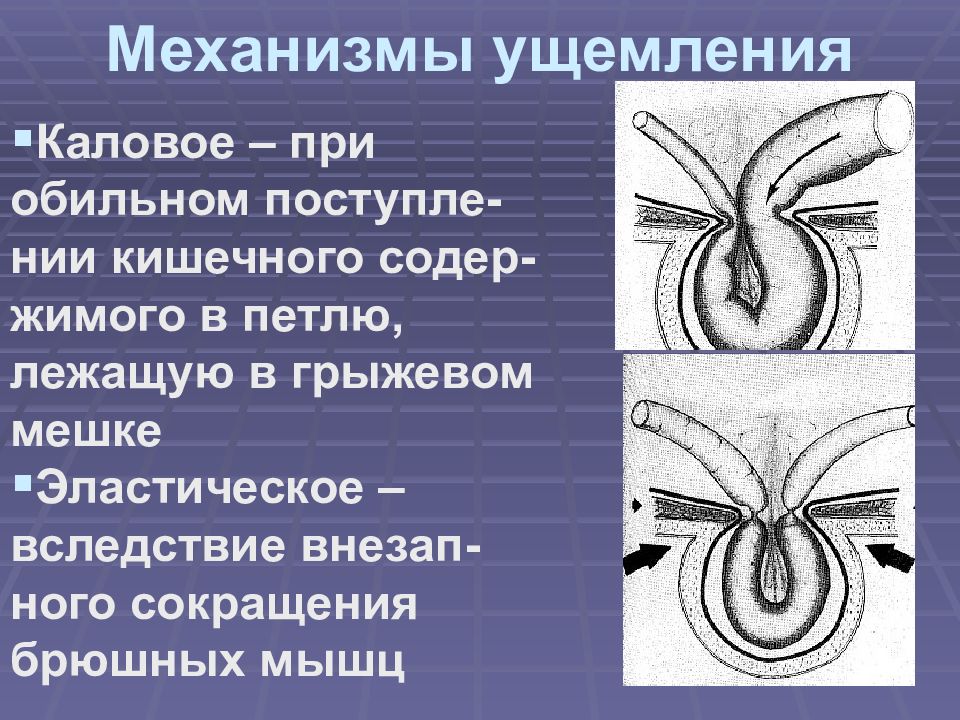 Грыжи живота презентация