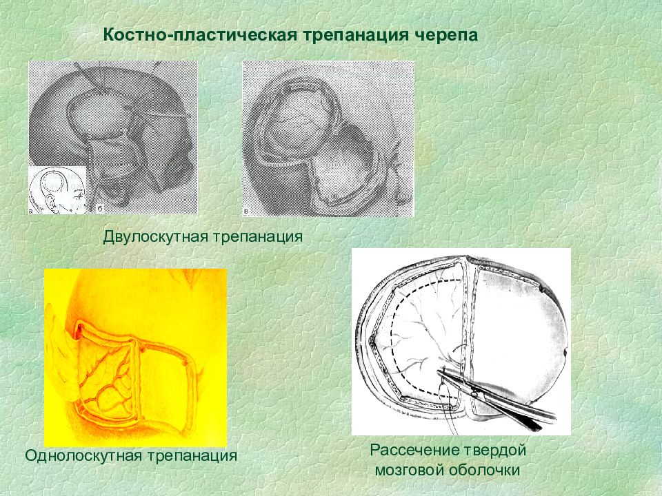 Трепанация черепа презентация