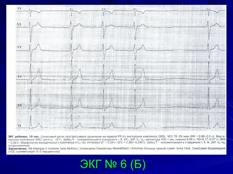 Блокада левой ножки синусовый ритм. Брадиаритмия на ЭКГ У ребенка. Блокады сердца на ЭКГ. Блокады у детей на ЭКГ. Что такое блокада сердца на ЭКГ У ребенка.
