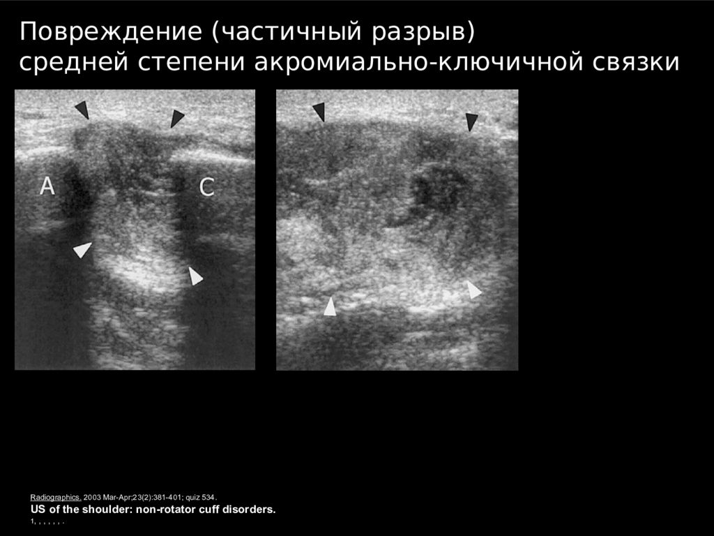 Узи плечевого. УЗИ связок плечевого сустава. УЗИ плечевого сустава лекция. УЗИ акромиально-ключичного сочленения. УЗИ плечевого сустава пособие.