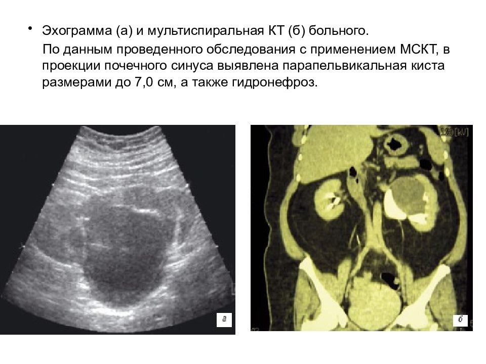 Диффузные изменения синуса обеих почек. Парапельвикальные кисты почек на кт. Парапельвикальная киста почки на кт.