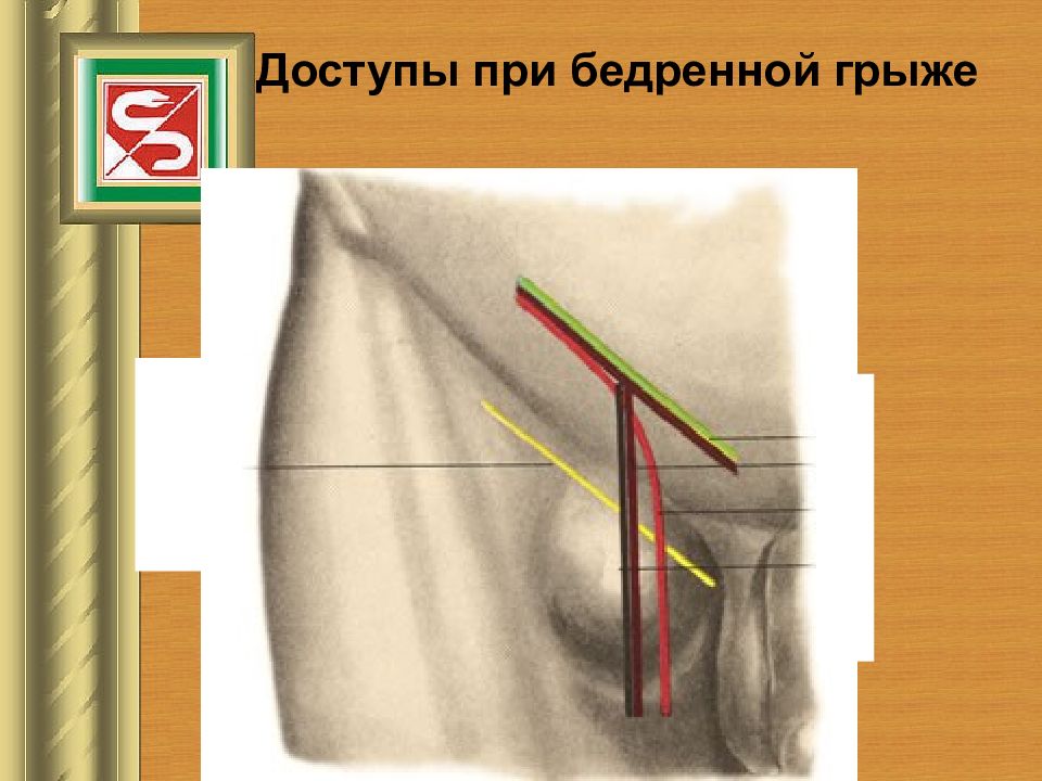 Левый пах. Паховая и бедренная грыжа. Бедренная грыжа и паховая грыжа. Пахово бедренная грыжа у женщин.