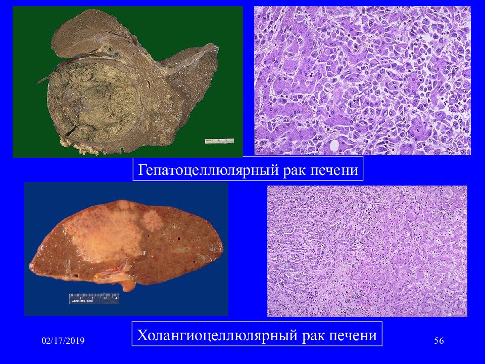 Гепатоцеллюлярный рак презентация