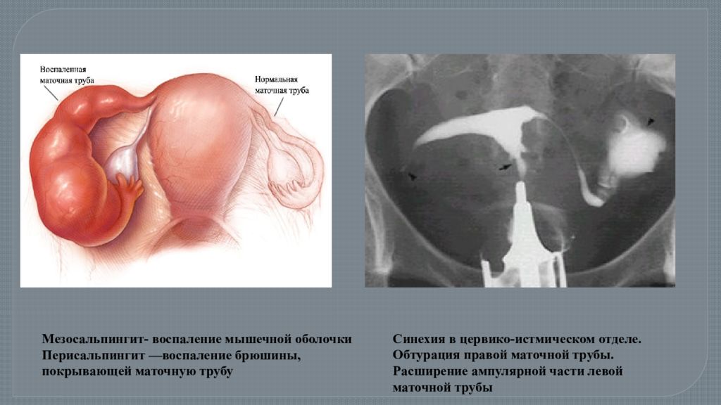 Воспаление труб. Истмикальный отдел маточной трубы. Интрамуральная часть маточной трубы. Ампулярной части фаллопиевой трубы. Расширение маточной трубы.