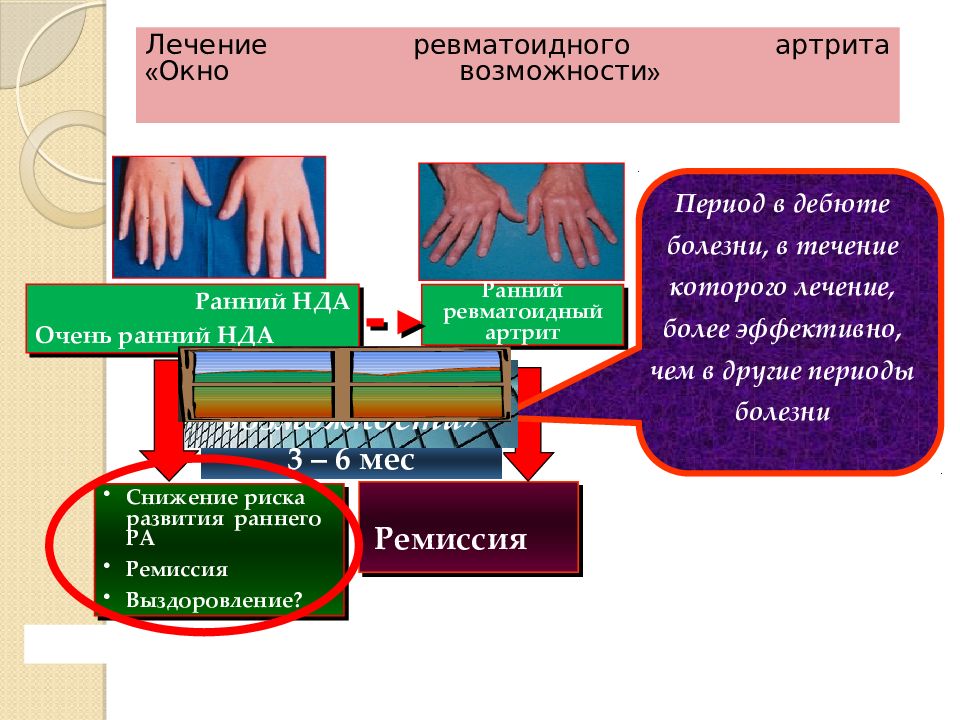 Течение ревматоидного артрита. Дебют ревматоидного артрита. Варианты течения ревматоидного артрита. Ревматоидный артрит презентация. Ремиссия ревматоидного артрита.