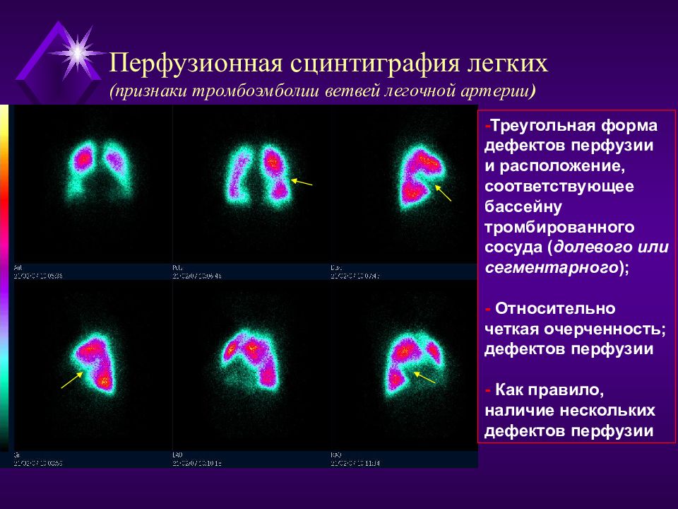 Сцинтиграмма является изображением