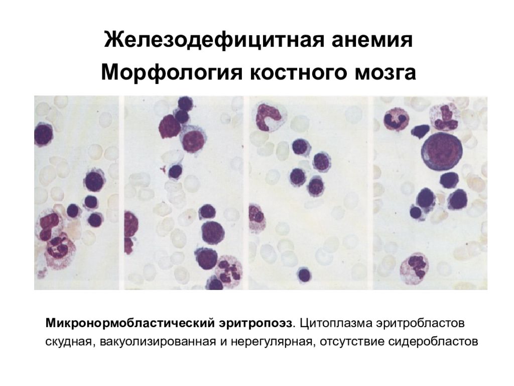 Морфология анемий. Морфология крови при железодефицитной анемии. Картина крови при железодефицитной анемии. Изменения в эритроцитах при железодефицитной анемии.