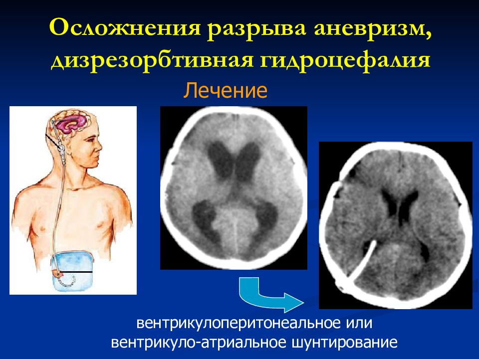 Гидроцефалия операция. Шунтирование гидроцефалии головного. Шунтирование гидроцефалии вентрикулоперитонеальное. Вентрикуло-перитонеальное шунтирование головного мозга. Осложнения вентрикулоперитонеального шунтирования.