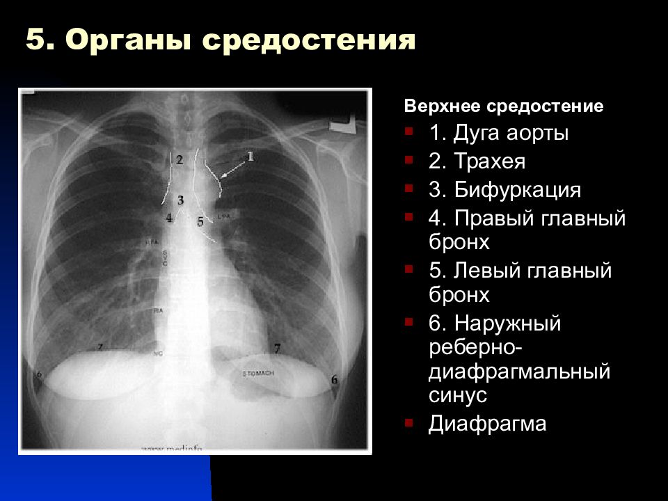 Лучевая диагностика органов средостения презентация