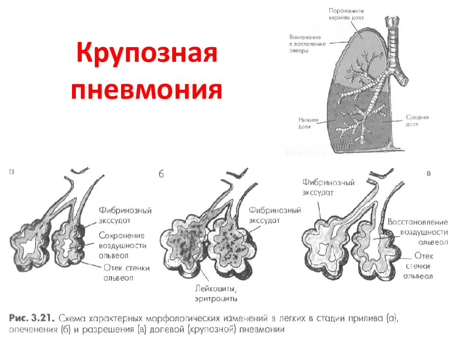Стадии развития легких. Схема патогенеза крупозной пневмонии. Очаговая пневмония стадии развития. Стадии патогенеза крупозной пневмонии. Крупозная пневмония крепитация.