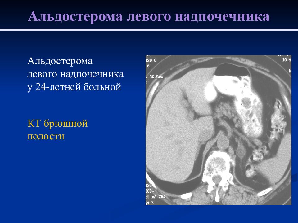 Туберкулез надпочечников. Альдостерома надпочечника на кт. Опухоли надпочечников мрт. Опухоли надпочечников на кт. Альдостерома левого надпочечника.