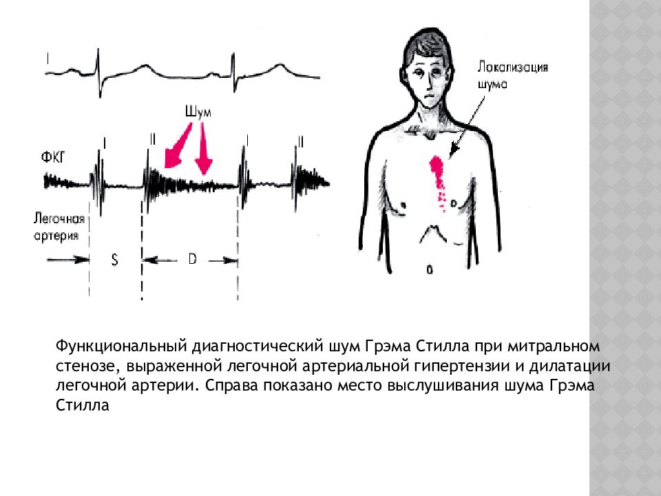 Шумы в сердце. ЭКГ при стенозе легочной артерии. Стеноз клапана легочной артерии аускультация. Стеноз легочной артерии аускультация. Стеноз легочного клапана аускультация.