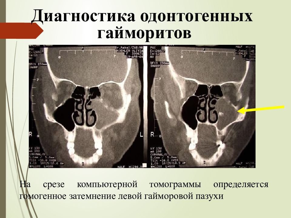 Одонтогенный гайморит презентация