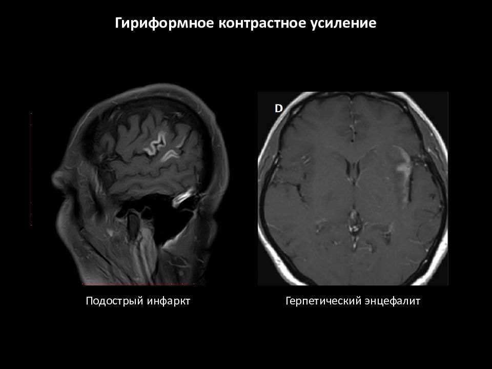 Мрт с контрастным усилением. Контрастное усиление. Болезнь Бинсвангера кт. Бинсвангера мрт.