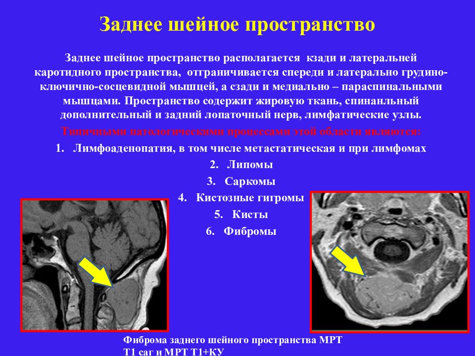 Пространство кт. Заднее шейное пространство. Заднее шейное пространство кт. Пространства шеи кт. Каротидное пространство кт.