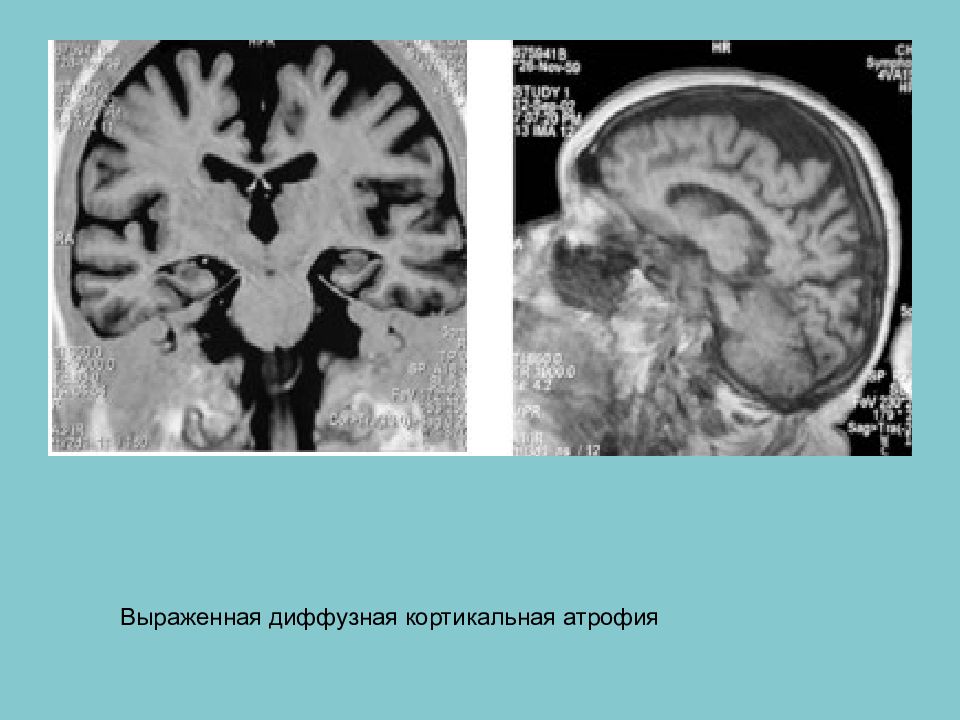 Мр картина расширения наружных ликворных пространств на фоне невыраженной кортикальной атрофии