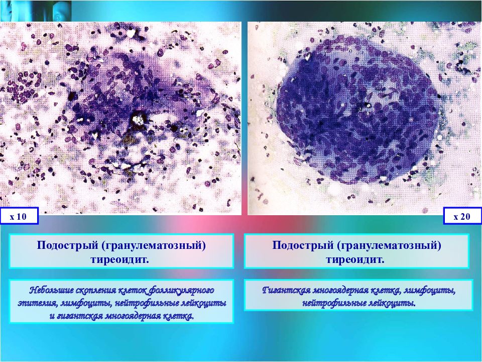 Цитологическая картина фолликулярной в клеточной опухоли щитовидной железы bethesda iv