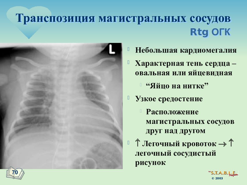 Транспозиция артерий