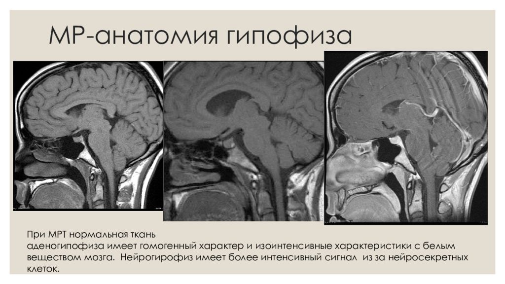 Мр картина диффузно неоднородной структуры гипофиза что это