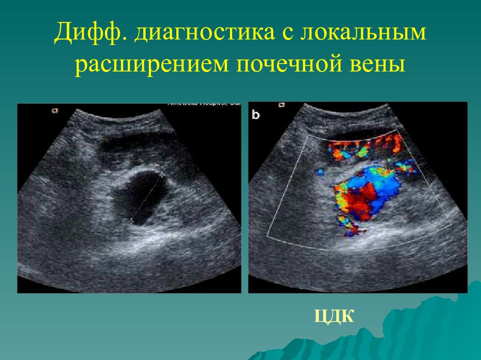 Узи почек утолщение стенок