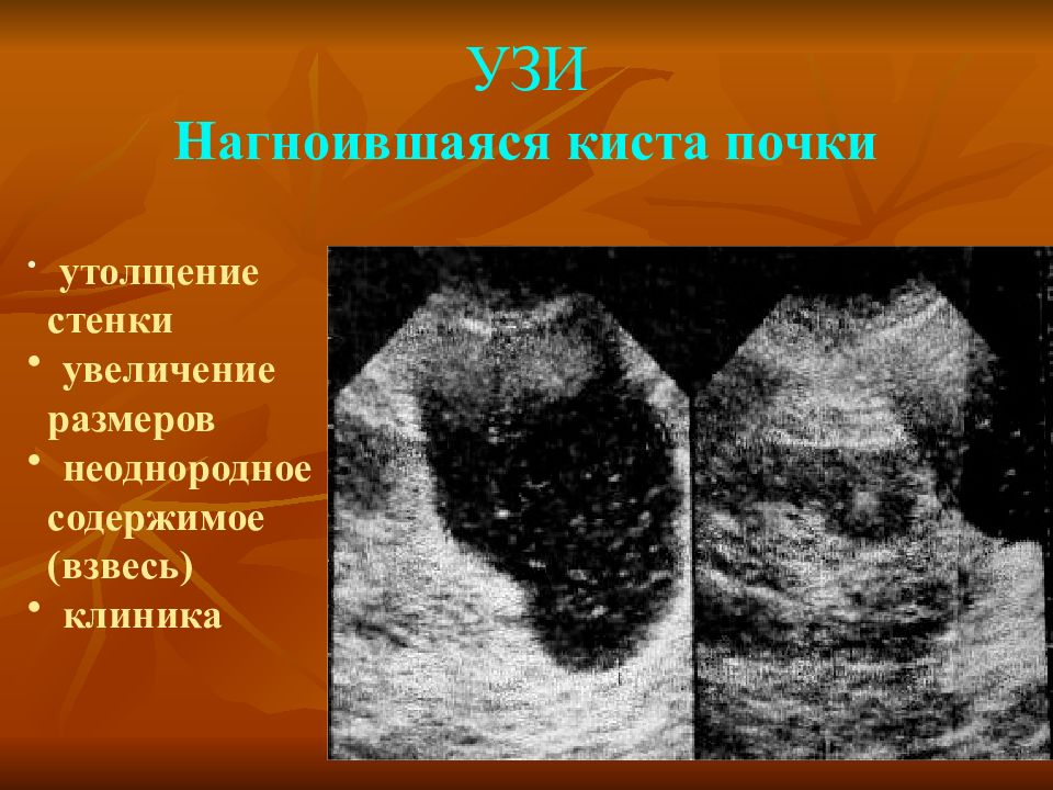 Киста в почке размеры норма. Нагноившаяся киста почки на УЗИ. Нефросклероз почек на УЗИ что это такое. Вторично сморщенная почка на УЗИ.