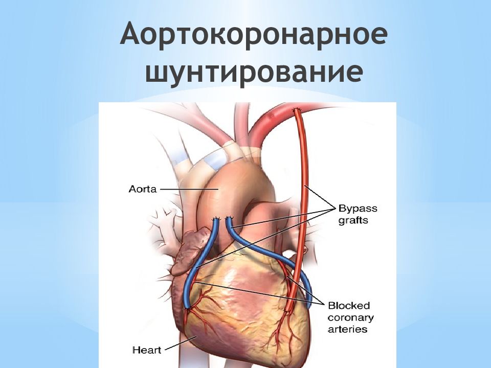 Что такое шунтирование сердца и сосудов. Операция на сердце коронарное шунтирование. Аортокоронарное шунтирование 3 шунта. Схема операции аортокоронарного шунтирования. Аортокоронарное шунтирование при ИБС.