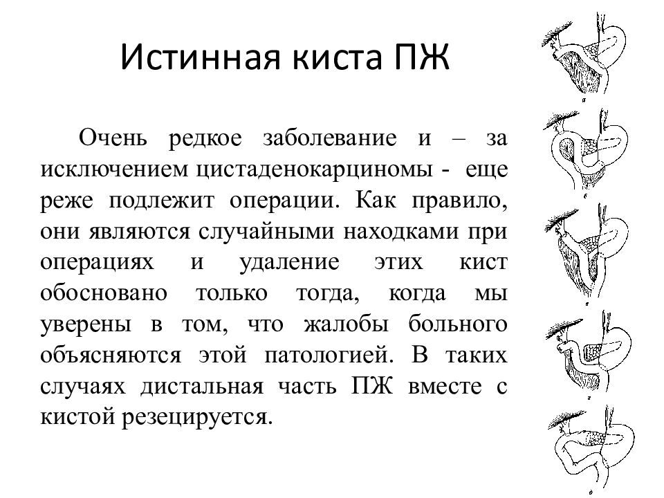 Кисты поджелудочной железы презентация