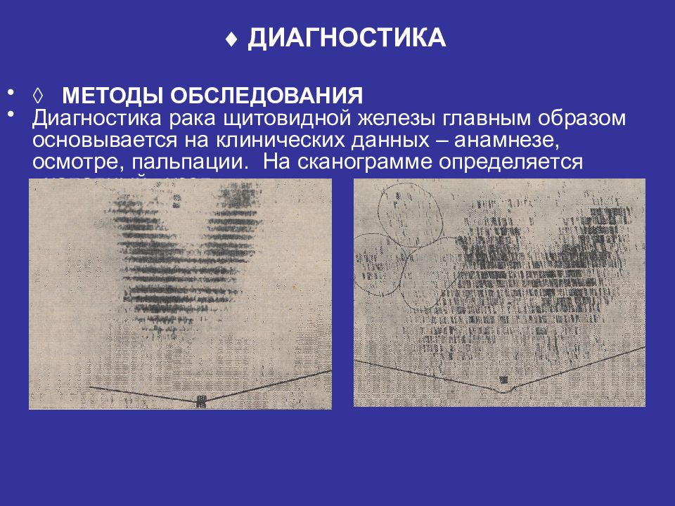 Диагностика щитовидной железы. Диагностика онкологии ЩЖ. Онкология щитовидной железы диагноз. Сканограмма щитовидной железы в норме. Диагностическое значение щитовидной железы.