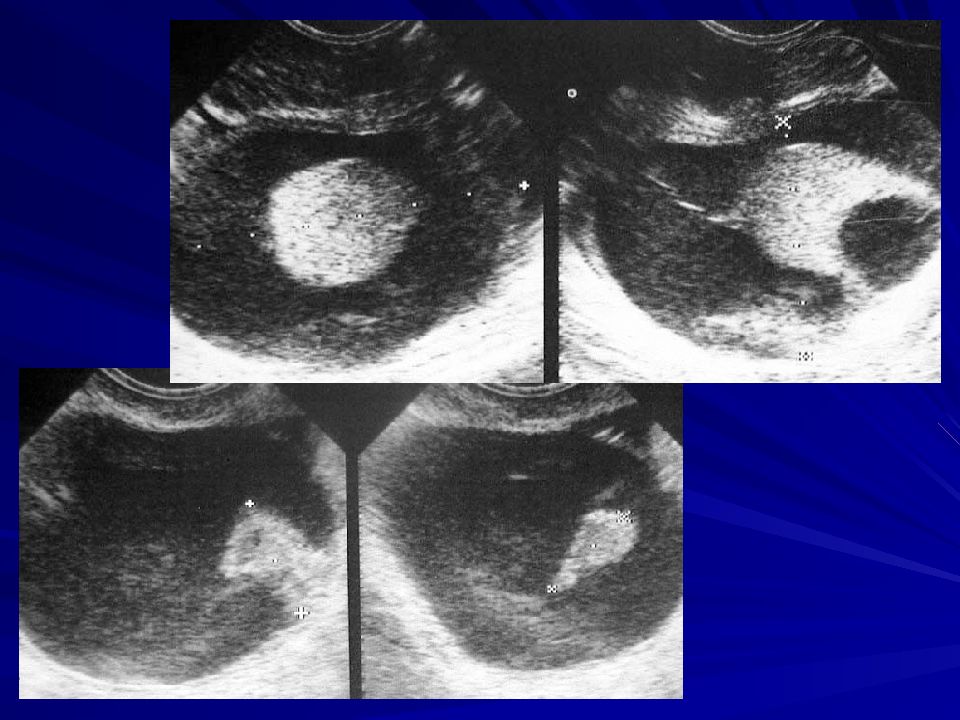 Субмукозная миома. Гидатида маточной трубы на УЗИ. Двурогая матка на УЗИ.