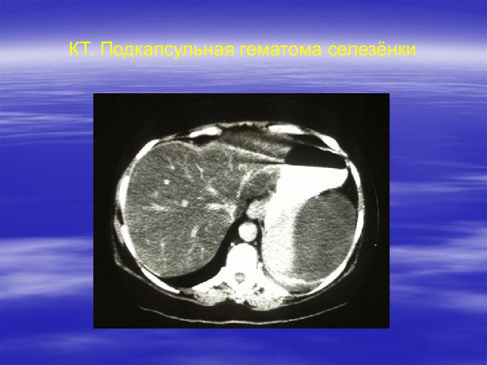 Гематома печени. Подкапсульная гематома селезенки на кт. Подкапсульный разрыв селезенки кт. Подкапсульный разрыв печени кт.