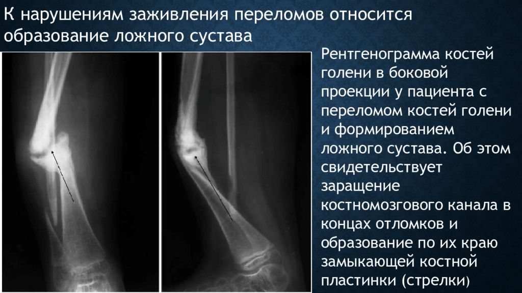 Перелом кости голени мкб 10. Псевдоартроз большеберцовой кости рентген. Ложный сустав малоберцовой кости рентген. Ложный сустав плечевой кости рентген. Ложный сустав на рентгене после перелома плечевой кости.