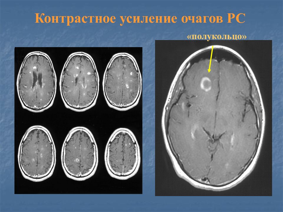 Очаги демиелинизации на мрт. Накопление контрастного вещества в новообразовании. Накопление контрастного вещества. Псевдотуморозная форма рассеянного склероза мрт. Очаги копят контраст.