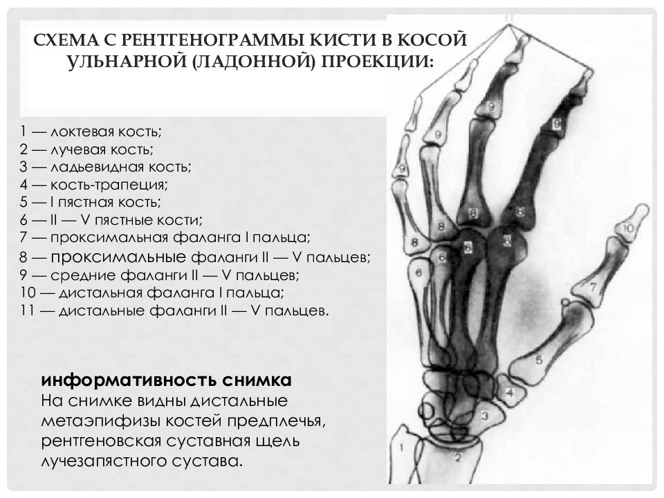 Лучевые кости кисти. Кости запястья рентген норма. Кости кисти лучезапястный сустав анатомия. Ладьевидная кость кисти анатомия. Рентген кистей в 2 проекциях.