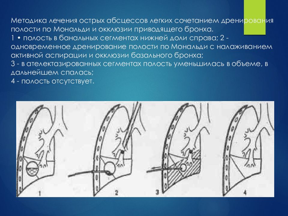 Полость острый. Трансторакальным дренированием по Мональди. Трансторакальное дренирование абсцесса легкого. Дренирование полости по Мональди. Дренирование абсцесса по Мональди.