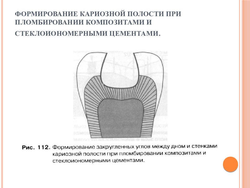 Размер кариозной полости