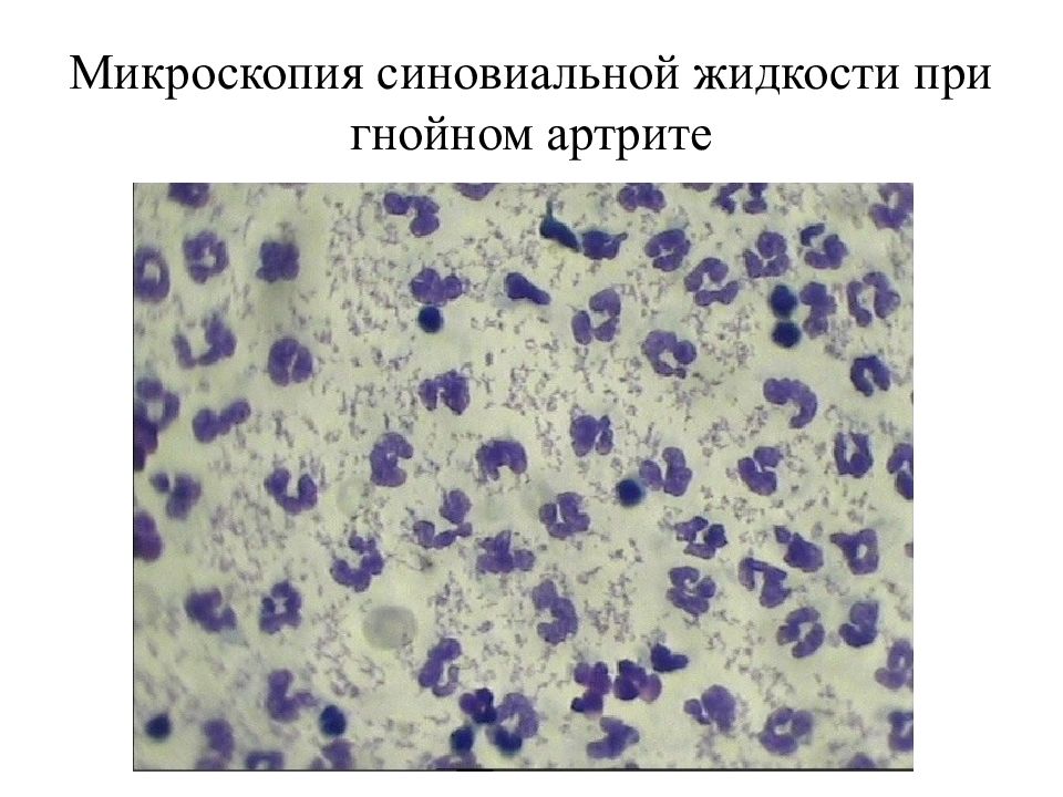 Цитология воспаления. Нейтрофилы цитология. Цитология Гнойного экссудата. Цитология синовиальной жидкости рагоциты. Микроскопия Гнойного экссудата.