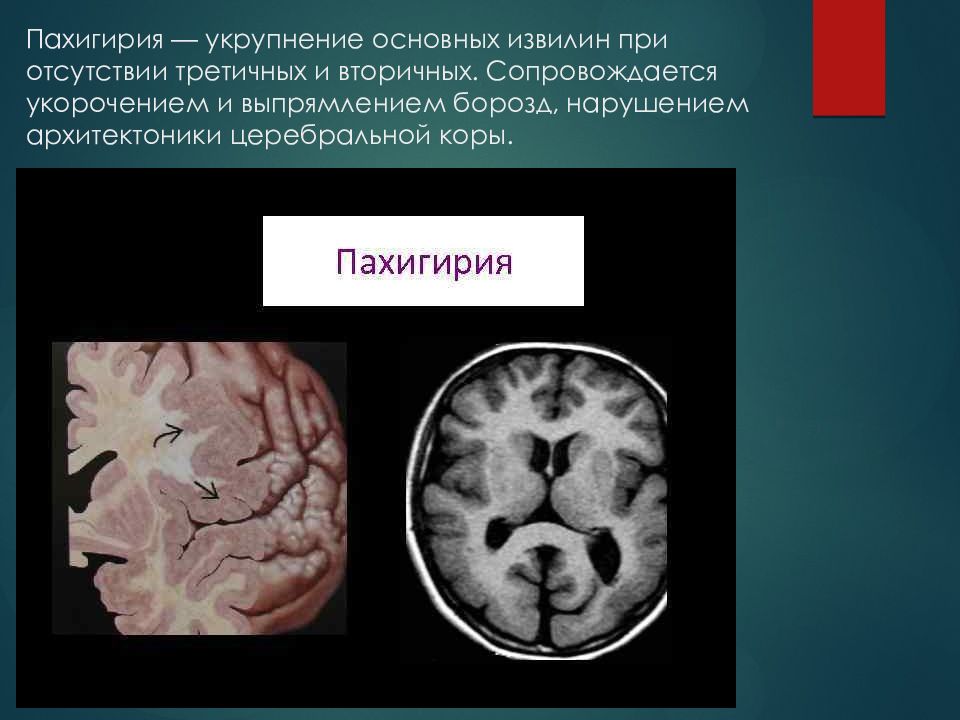 Нарушение развития головного мозга. Пахигирия и полимикрогирия. Лиссэнцефалия-пахигирия. Пороки развития головного мозга мрт. Пахигария головного мозга.