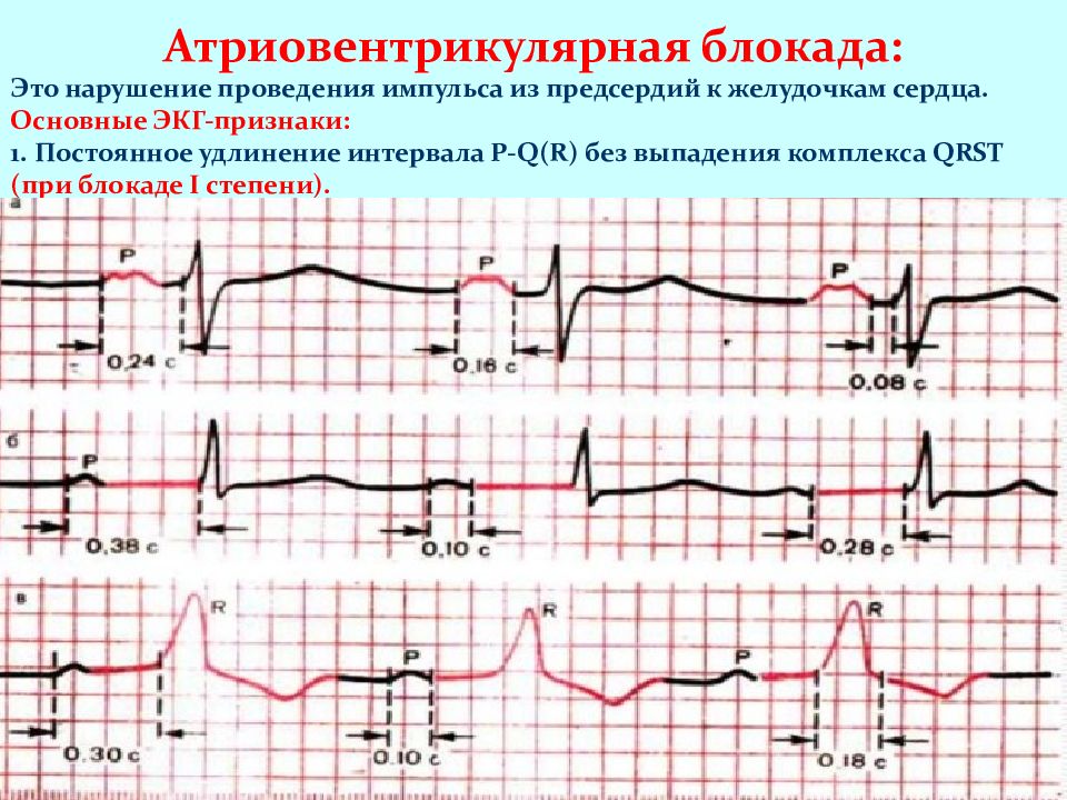 Экг при нарушениях ритма и проводимости презентация