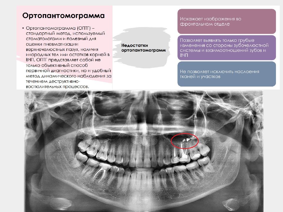 Верхнечелюстной синусит презентация