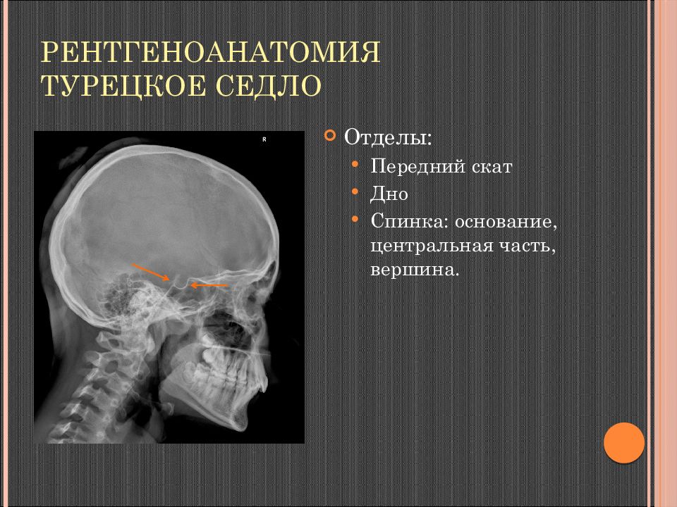 Формирующееся турецкое седло в головном мозге. Диплоические вены костей свода черепа рентген. Диплоические вены костей свода черепа кт. Синдром пустого турецкого седла клинические рекомендации.