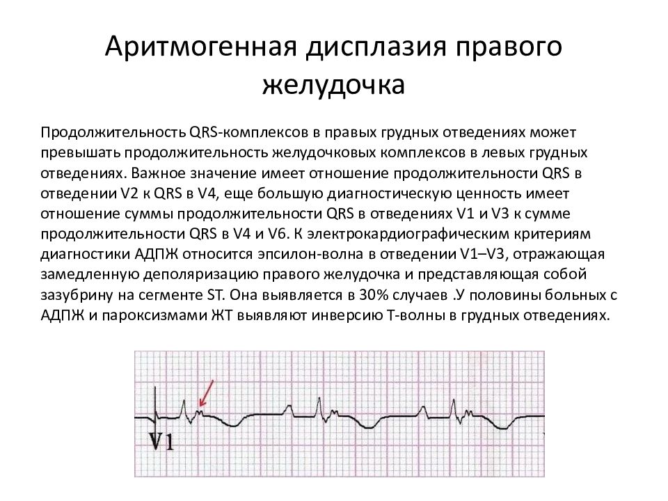 Подъем сегмента st. Подъем сегмента St на ЭКГ v3. Корытообразный сегмент St на ЭКГ. Инфаркт ЭКГ элевация St. Элевация сегмента St в v1-v6.