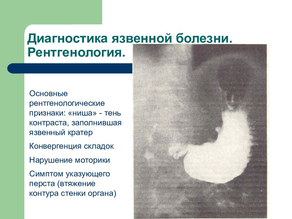 Клиническая картина при прободной язве желудка и 12 ти перстной кишки