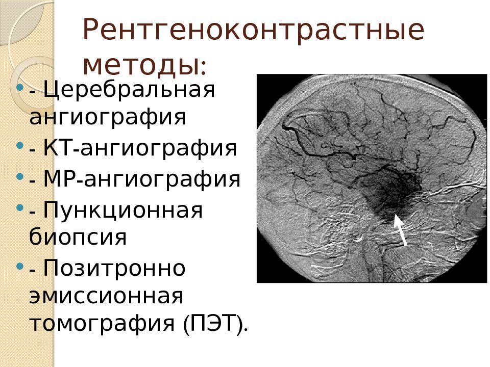 Объемное образование головного мозга код. Опухоли головного мозга презентация. Метод церебральной ангиографии. Ангиография головного мозга опухоль. Церебральная процедура.
