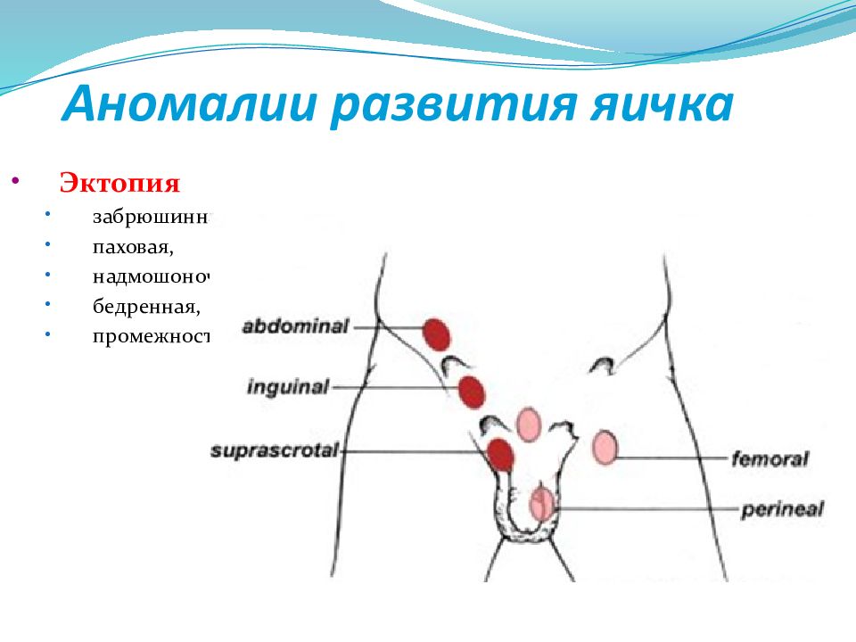 Анорхизм яичек картинка