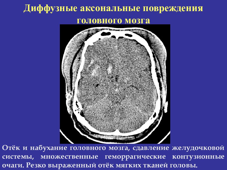 Диффузная травма головного. Диффузное аксональное повреждение головного мозга кт. Контузионный очаг мозга кт. Контузионный очаг 1 типа на кт. Очаги ушиба головного мозга на кт.