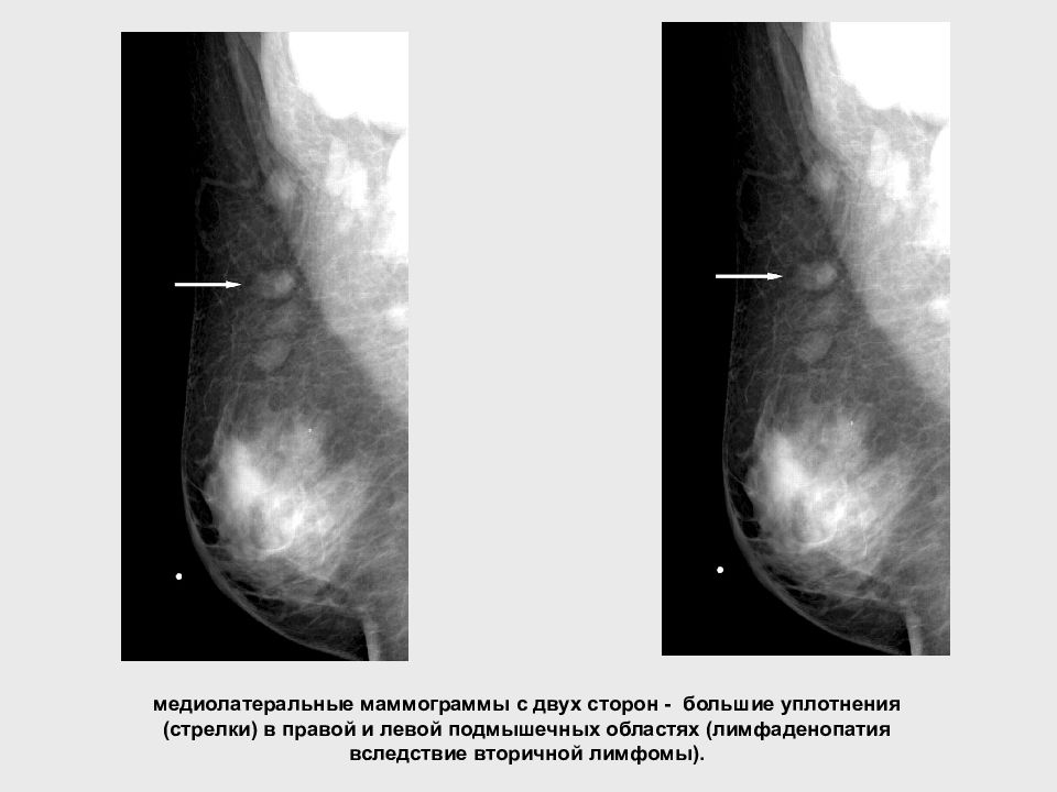 Аксиллярный лимфоузел молочной железы что это такое. Лимфоаденопатия маммограмма. Лимфатические узлы на маммографии. Лимфаденопатия маммография. Лимфоузлы молочной железы маммография.